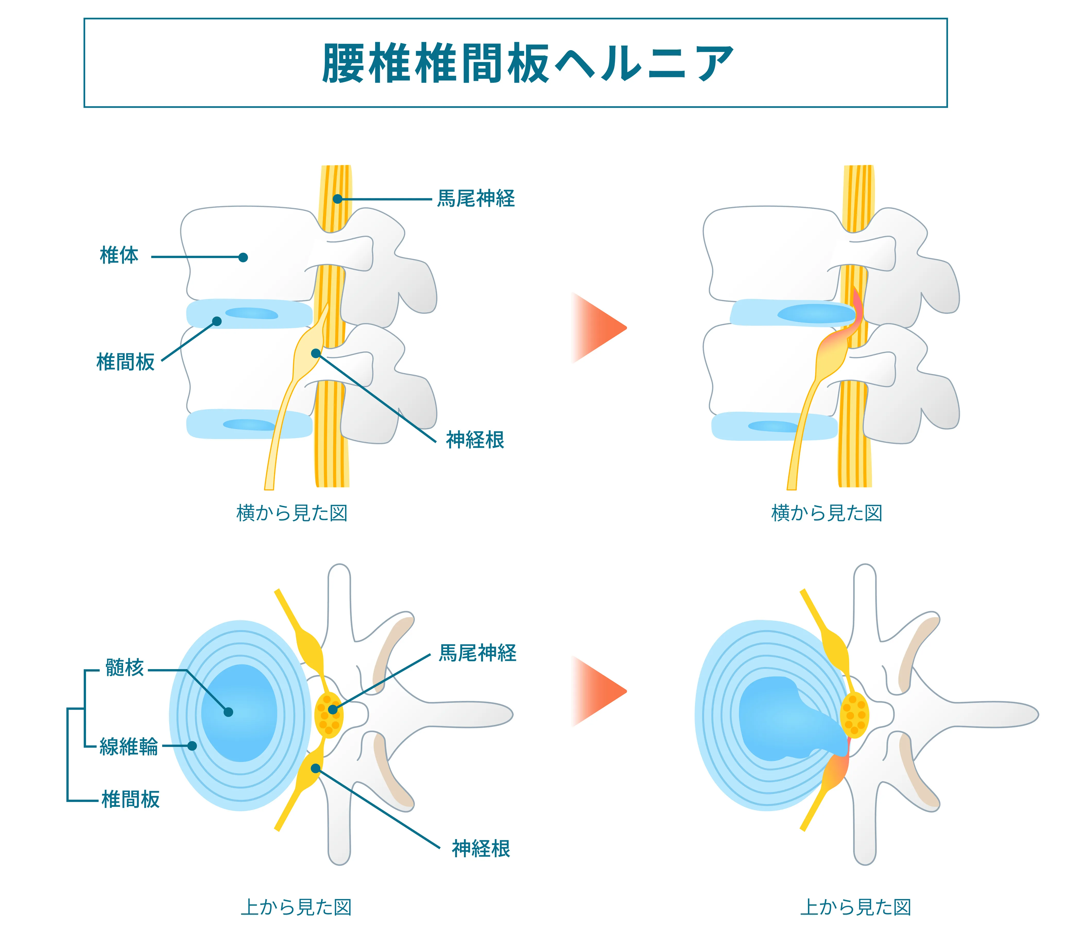 椎間板ヘルニアの図解イラスト